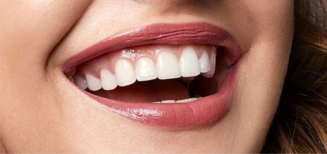 Deep Bite Treatment