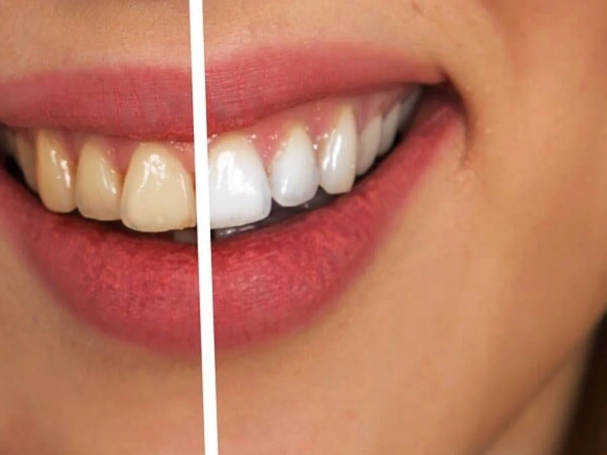 Dental Fluorosis Treatment