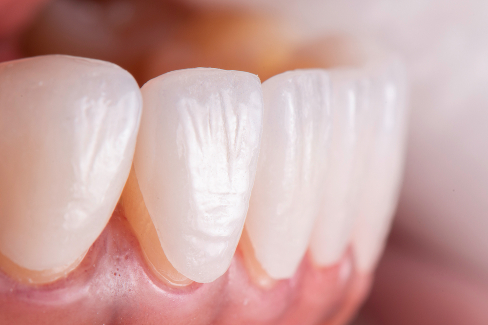 Dental Laminates