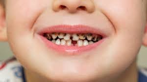 Early Childhood Caries Treatment